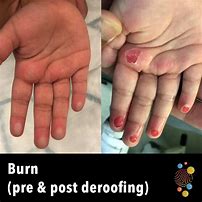 Image result for Healing Burn Blister