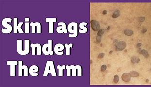 Image result for HPV Virus Skin Tags