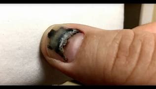 Image result for Smashed Fingernail