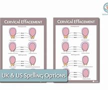 Image result for Effaced Cervix Picture