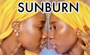 Image result for Sun Burn African Skin