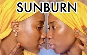 Image result for SunBurn Black Skin