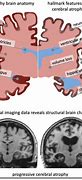 Image result for Brain Shrinking Disease Symptoms