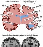 Image result for Geriatric Brain Shrinking