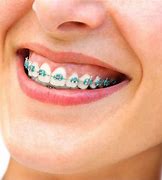 Image result for Teal Braces for Teeh