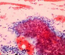 Image result for Human Papillomavirus Infection Cervical Cancer