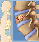 Image result for Compression Fracture Lumbar Spine