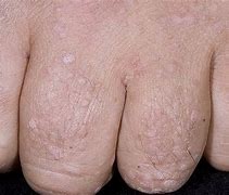 Image result for Flat Warts On Hands Cause
