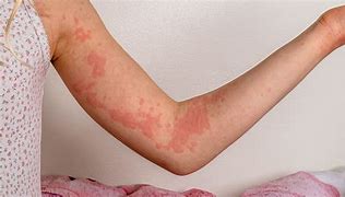 Image result for Hives Allergic Reaction Skin Rash