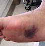 Image result for Lisfranc Injury