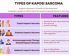 Image result for Epidemic Kaposi Sarcoma
