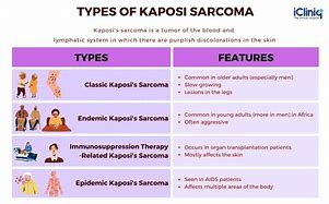 Image result for Kaposi Sarcoma Symptoms