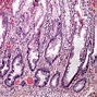 Image result for Sessile Polyp Cecum