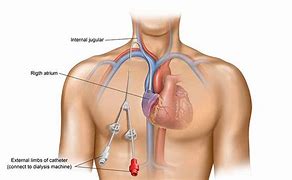 Image result for Central Venous Catheter Cleaning