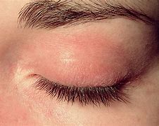 Image result for Red Swollen Itchy Eyes