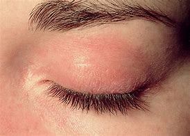 Image result for Itchy Rash On Eyelids