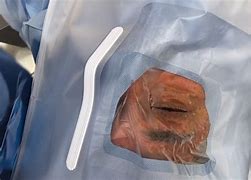 Image result for Drape Clips Surgery