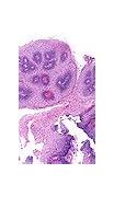 Image result for Squamous Cell Papilloma