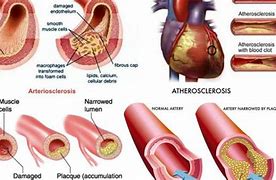 Image result for arteriosclerosis