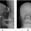 Image result for Vertical Dimension with Bruxism