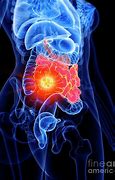 Image result for Picture Full Intestinal Small Bowel Cancer