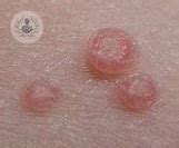 Image result for Molluscum Contagiosum On Hand Adults