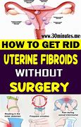 Image result for 10 Cm Uterine Fibroid