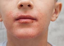 Image result for Allergic Skin Rash On Face