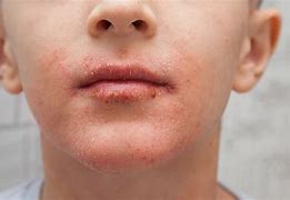 Image result for Food Allergy Reaction Skin Rash