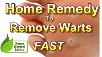 Image result for wart removal home remedies