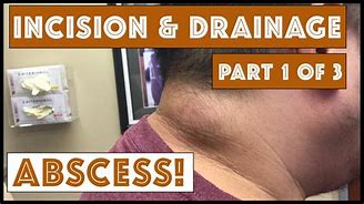 Image result for Ir Abscess Drain