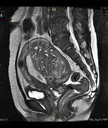 Image result for 8Mm Cyst