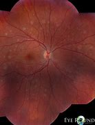 Image result for White Spots On Retina