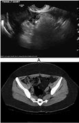 Image result for Ovarian Cyst CT Scan Contrast