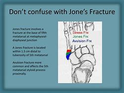 Image result for Jones Fracture vs Dancers Fracture