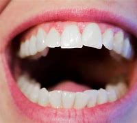 Image result for dentecer