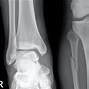 Image result for What Is a Maisonneuve Fracture