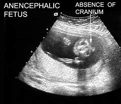 Image result for Anencephaly Fetal Brain Ultrasound