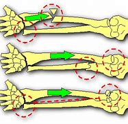 Image result for Galeazzi Fracture