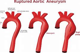 Image result for Aortic Aneurysm Measurements