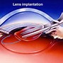 Image result for Cataract Lenses