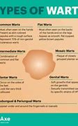 Image result for Causes of Genital Warts