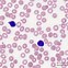 Image result for T-cell Prolymphocytic Leukemia