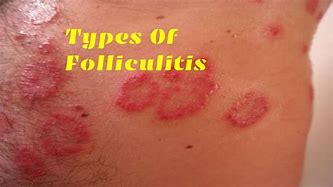 Image result for Folliculitis