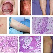 Image result for Pedunculated Warts Genital