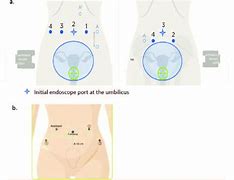 Image result for Robotic Hysterectomy Port Placement