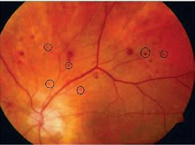 Image result for Microaneurysms Retina Histology