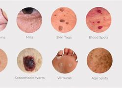 Image result for Wart Like Skin Tags Pictures