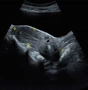 Image result for Cervical Fibroid Ultrasound