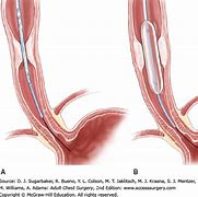 Image result for Esophageal Stricture Surgery